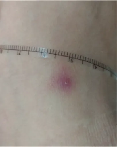 Figure 2. A photograph of Case 2. Three days after doxycycline therapy, an erythematous patch of 9 × 10 mm in  diameter is noticed on the left ankle with desquamation at the center of the erythema.