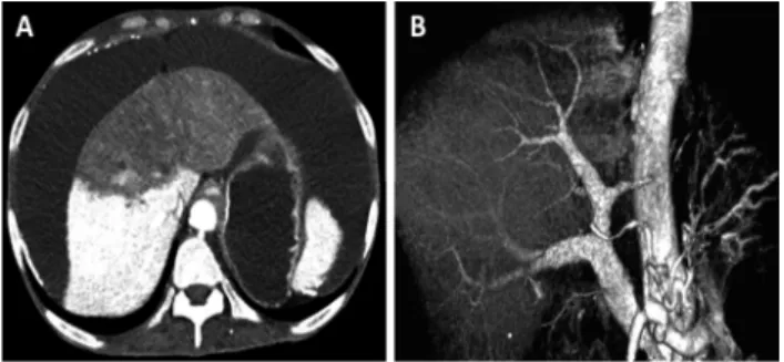 Fig. 2. Further liver imaging. (A) Abdominal CT shows infarction of the left lobe of the liver and massive ascites