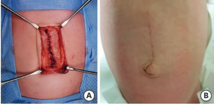 Fig. 6. Closure of the hernia. 