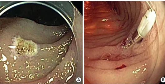 Fig. 2. Intraoperative endoscopy. Multiple bleeding foci were treated with (A) argon plasma coagulations and   (B) hemo-clippings.