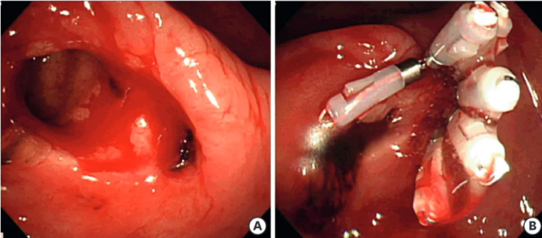 Fig. 1. Colonoscopy bleeding control at first visit. Patient presents with cecal diverticular bleeding (A) and  hemostasis has been controlled using hemoclip (B).