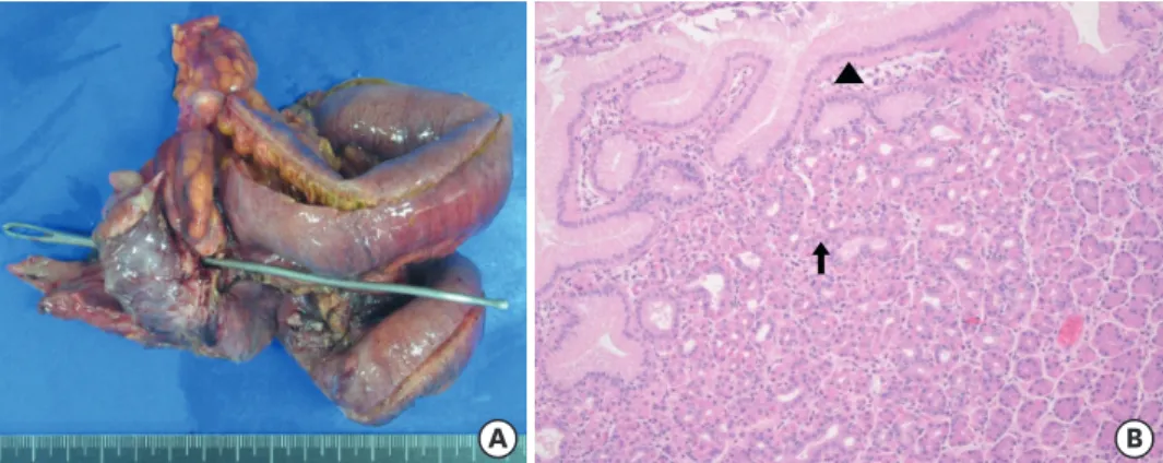 Fig. 3. Gross and microscopic finding. (A) Specimen from the ileocecal resection showing cecal perforation