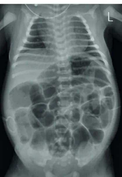 Fig. 1. Simple radiograph showing marked distension of the bowel.