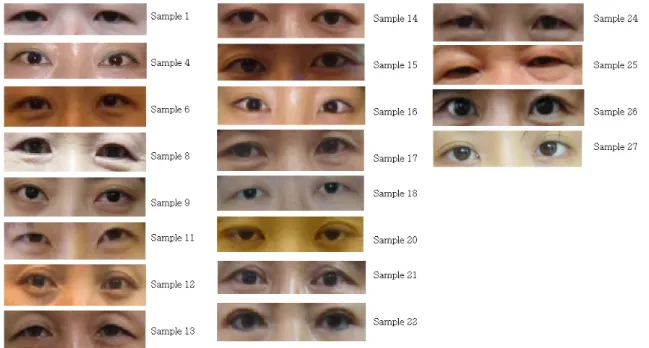 Table 2. Intraclass Correlation Coefficients of Eyes Calculated by One Clinician (Intra - rater reliability)Figure 4