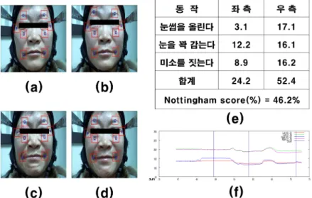 Fig 7. Results of a normal subject (a) At rest (b) Maximal-effort eyebrow raising (c) Closing eyes tightly  (d) Smiling (e) Results of Nottingham score (f) Graphs of the time history of distances