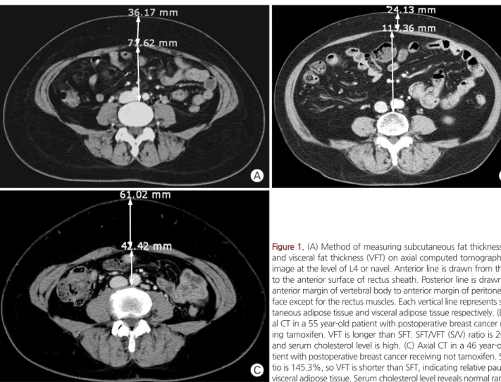 Figure 1. (A) Method of measuring subcutaneous fat thickness (SFT)  and visceral fat thickness (VFT) on axial computed tomography (CT)  image at the level of L4 or navel