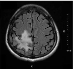 Figure  1.  Brain-MR  (T2  FLAIR,  2009/03/06)① 침치료: 오전 9시 안면, 사지 體針 자침 후 30분간 留針② 직접구:  좌측 팔풍,  충양,  해계 각 5장③ 미립대:  백회 목창 각 3장④ 건부항:  요부 10분 留罐Ⅲ