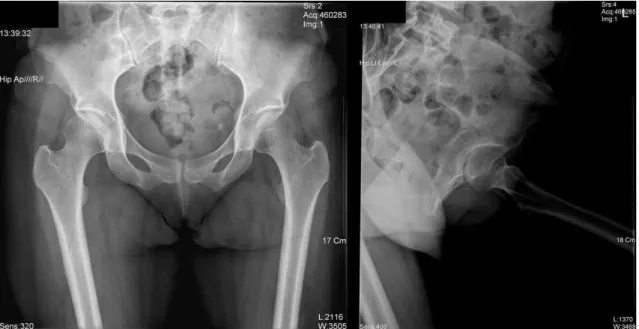 Figure  2.  Hip  joint  X-ray  (2009/05/09)