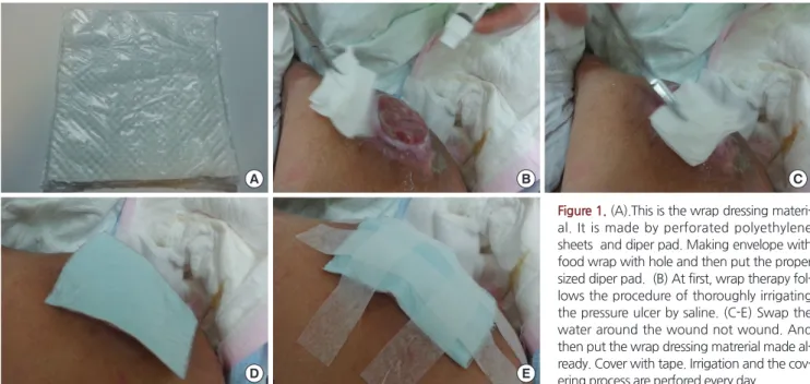 Figure 1. (A).This is the wrap dressing materi- materi-al. It is made by perforated polyethylene  sheets  and diper pad