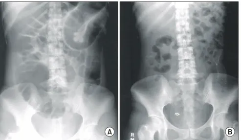 Fig.  1.  Plain  abdominal  radiography  before  (A)  and  after  (B)  stent  deployment  in  sigmoid  colon