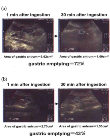 Fig 3. Abdominal ultrasonogram of an elderly subject who received food orally (panel a)  and that for a subject who underwent tubal feeding (panel b).