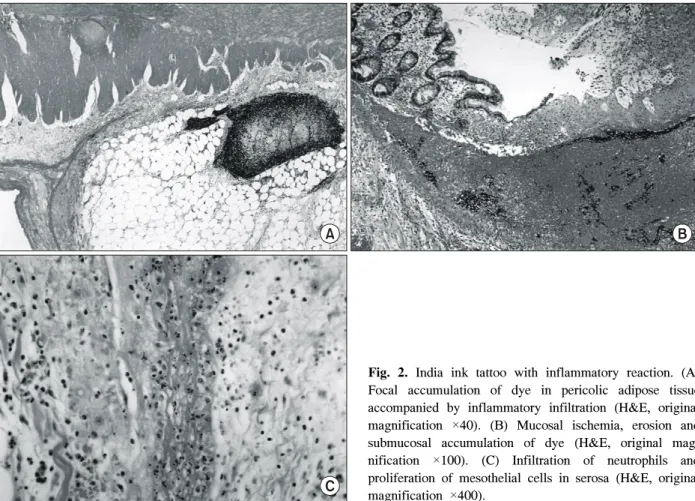 Fig.  2.  India  ink  tattoo  with  inflammatory  reaction.  (A)  Focal  accumulation  of  dye  in  pericolic  adipose  tissue  accompanied  by  inflammatory  infiltration  (H&amp;E,  original  magnification  ×40)