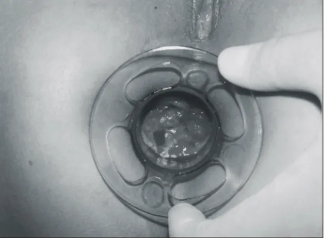 Fig.  3.  Closing  and  firing.  Moderate  traction  on  the  purse- purse-string  when  inserting  the  stapler  draws  the  mucosal  prolapse  into  the  head  of  the  stapler.