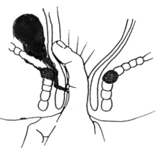 Fig.  2.  Suprasphincteric  type;  difficult  to  differentiate  puborectal  is  due  to  fibrosis  of  posterior  rectal  wall.