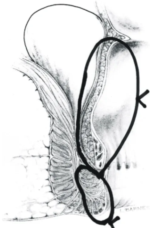 Table  3.  Fistula  healing  and  postoperative  function ꠚꠚꠚꠚꠚꠚꠚꠚꠚꠚꠚꠚꠚꠚꠚꠚꠚꠚꠚꠚꠚꠚꠚꠚꠚꠚꠚꠚꠚꠚꠚꠚꠚꠚꠚꠚꠚꠚꠚꠚꠚꠚꠚꠚꠚꠚꠚꠚꠚ