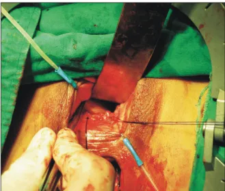 Fig.  4.  The  skin  paddle  is  secured  with  interrupted  3-0  PDS  sutures.