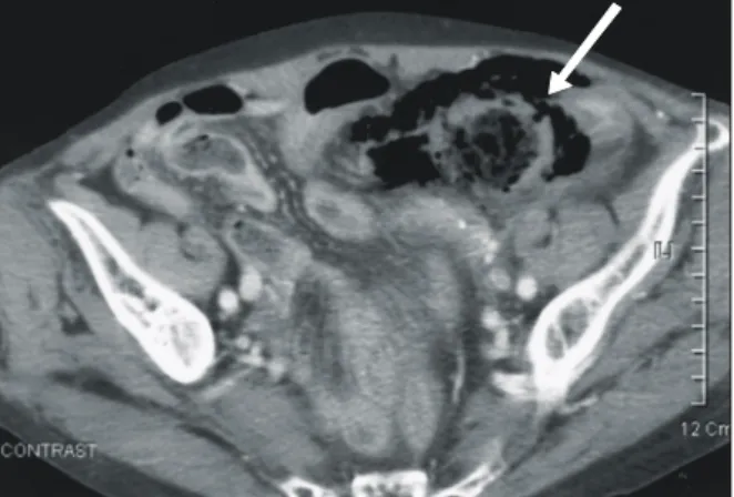 Fig.  3.  Gross  finding  of  the  sigmoid  colon  showed  large  perforation  (about  4.5×2.5  cm).