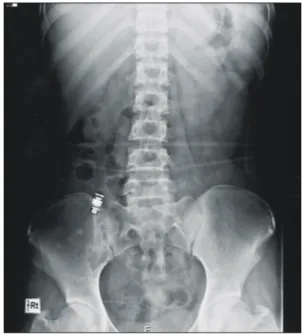 Fig.  3.  Short  segmental  luminal  narrowing  at  proximal  ileum  with  a  video  capsule  endoscopy  in  the  proximal  ileal  loop.