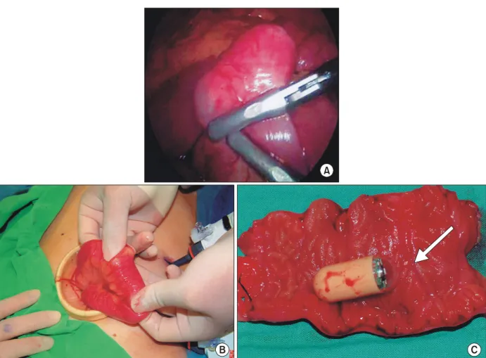Fig.  5.  Multifocal  mucosal  erosion  with  granulation  tissue  formation  and  lymphoid  follicles  with  no  evidence  of  tuberculosis  or  Crohn's  disease.