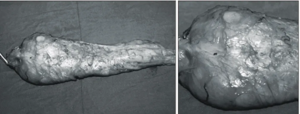 Fig.  1.  T2-weight  spin-echo  Magnetic  resonance  image  pelvimetric  images.  (A)  Midsagittal  section  shows  the  obstetric  conjugate  of  10.0  cm  and  length  of  sacrum  of  11.0  cm