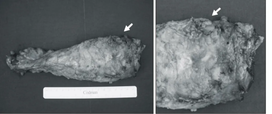 Fig.  3.  Macroscopic  assessment  of  specimen  surface.  This   speci-men  was  nearly  complete  grade