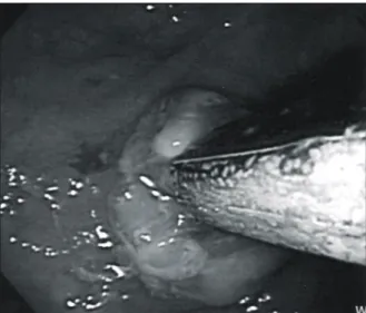 Fig.  1.  The  plain  abdominal  film  shows  brush  shaped  radio- radio-opaque  density  in  ascending  colon  (arrow).