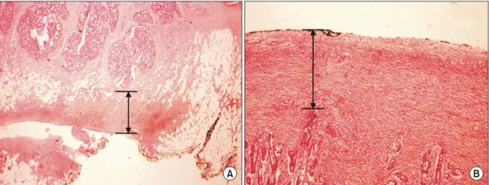 Fig.  1.  Pathologic  measurement  of  distance  between  tumor  and  circumferential  resection  margin