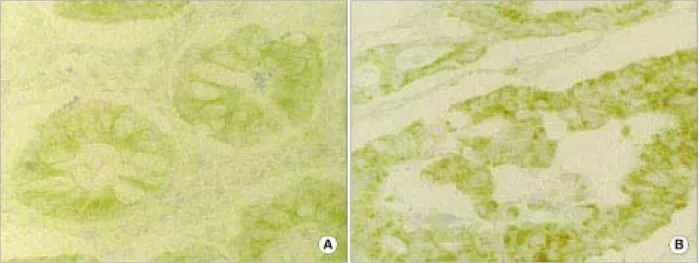 Fig.  1.  Immunohistochemical  staining  of  EGFR  expression  in  colorectal  cancer