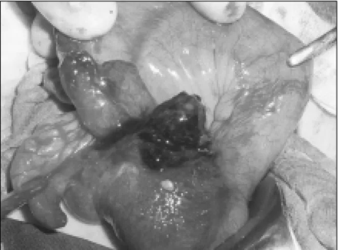 Fig.  2.  Operative  finding;  hematoma  and  inflammatory  changes  was  seen  in  cecum,  but  terminal  ileum  was  normal