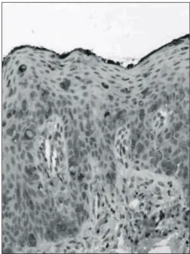Fig.  5.  The  anal  duct  adenocarcinoma.