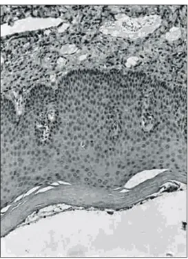 Fig.  7.  The  immunohistochemical  stain:  the  Paget's  cell  was  negative  for  CEA.