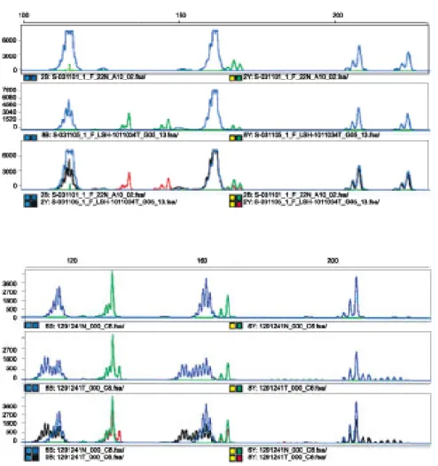 Fig.  3.  Example  of  high-level  microsatellite  instability  (MSI-  H).  Fragment  pattern  of   ampli-fied  PCR  products  from  a   tu-mor  that  is  unstable  at  all  five  analyzed  microsatellite  loci.