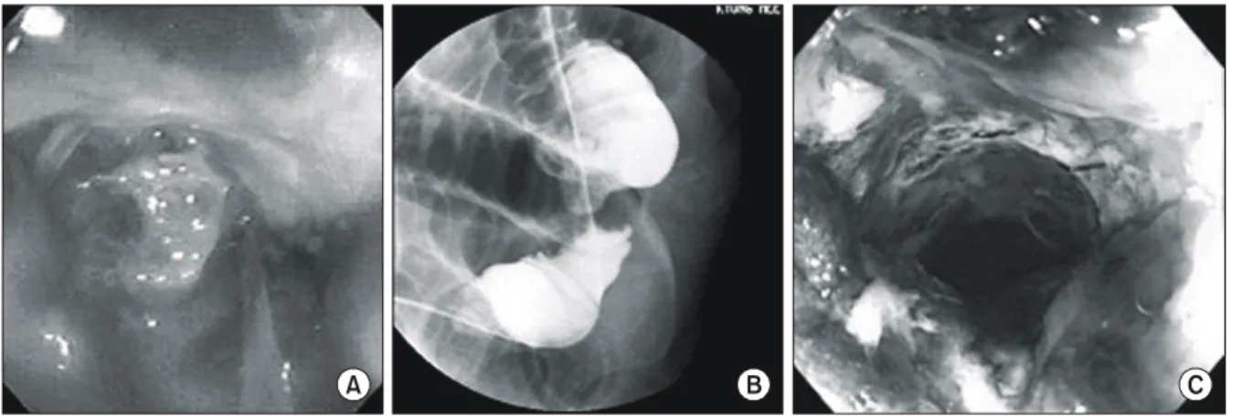 Fig.  1.  Initial  simple  X-ray  of  a  patient  with  malignant  colonic  obstruction.