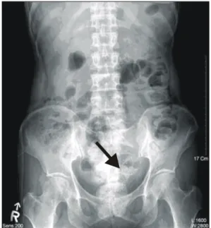 Table  2.  Change  of  APACHE  II  score  after  stent  insertion ꠚꠚꠚꠚꠚꠚꠚꠚꠚꠚꠚꠚꠚꠚꠚꠚꠚꠚꠚꠚꠚꠚꠚꠚꠚꠚꠚꠚꠚꠚꠚꠚꠚꠚꠚꠚꠚꠚꠚꠚꠚꠚꠚꠚꠚꠚꠚꠚꠚ