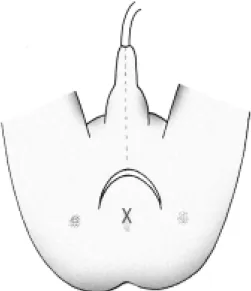Fig.  1.  Preanal  extraspincteric  incision:  Bilateral  ischial  tuberosity  was  marked,  and  semicircular  incion  was   per-formed