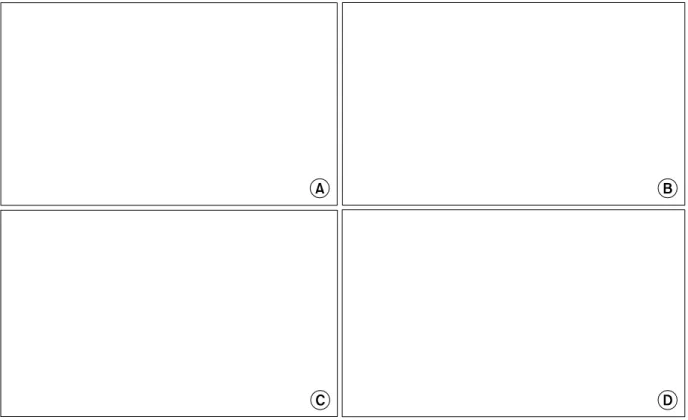 Fig.  1.  PTEN  immunohistochemical  staining  patterns  of  the  colorectal  cancer  tissue  (×100)