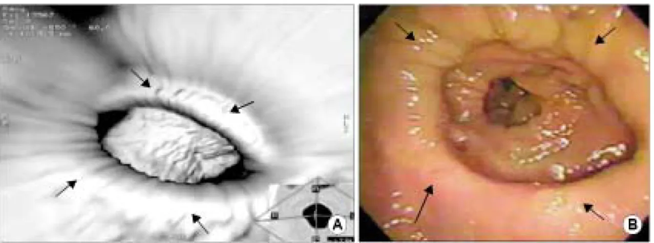 Fig.  1.  Sectional  success  rate  of  virtual  colonoscopy  in  pos- pos-toperative  colon  cancer  patients  (CE  =  cecum;  HF  =  hepatic  flexure;  SF  =  splenic  flexure;  SC  =  sigmoid  colon;  RE  =  rectum; 