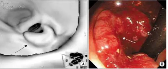 Fig.  5.  Comparison  of  the  detection  rate  of  cancers  and  polyps  between  conventional  colonoscopy  and  virtual  colonoscopy  (CFS  =  conventional  colonoscopy;  VC  =  virtual  colonoscopy; 