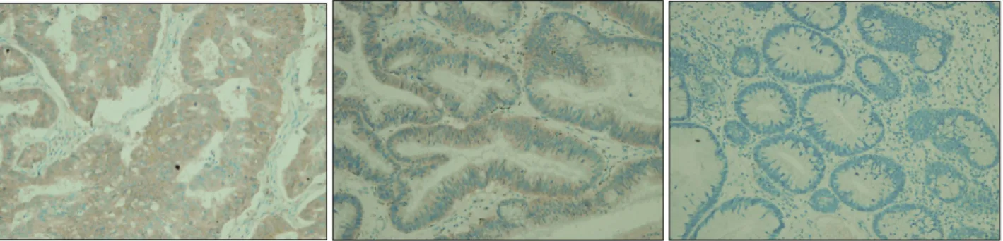 Fig.  1.  Immunohistochemical  stains  for  c-Met  protein  (×400).