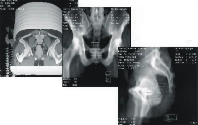 Fig.  1.  3  Dimensional  CT  tumor  volumetric  analysis;  tomur  volume  was  108  cc  before  chemoradiation  therapy.