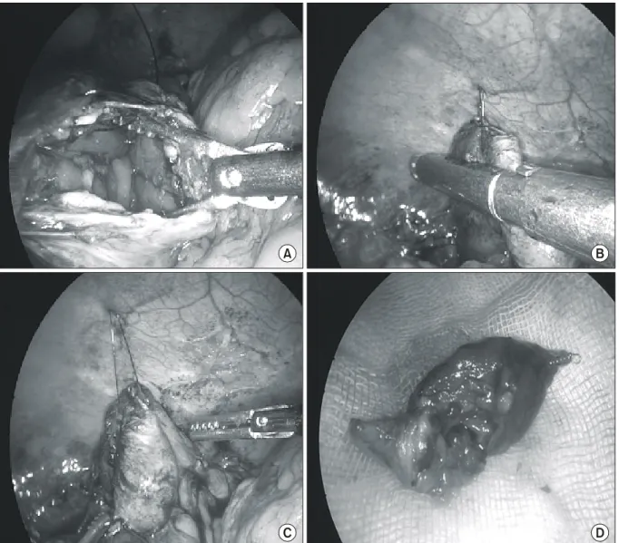 Fig.  1.  Percutaneous  suture  “hang-up”  technique  and  stapled  closure.  (A)  The  perforated  cecum  was  identified  and  full  thickness  suture  was  done  for  hanging  up  the  lesion