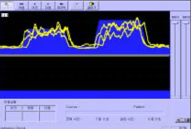 Fig.  1.  Synchronous  two  channels  (anal/abdominal)  EMG  signal  display  for  biofeedback  therapy.