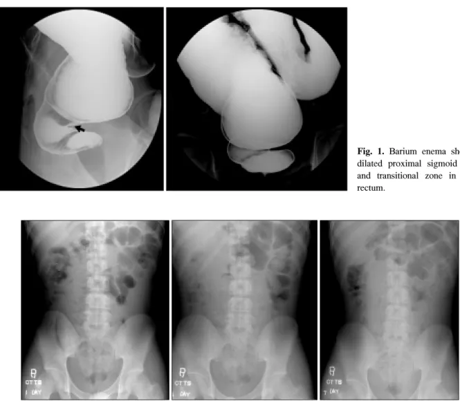Fig.  1.  Barium  enema  shows  a  dilated  proximal  sigmoid  colon  and  transitional  zone  in  upper  rectum.