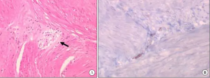 Fig.  4.  Markedly  dilated  sigmoid  colon  and  rectum  were  noted  on  operative  field