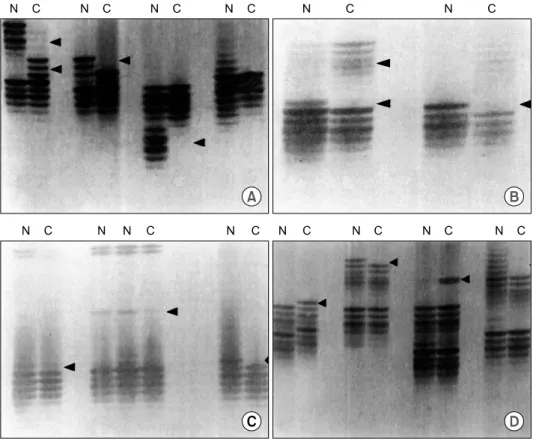 Fig.  1.  Microsatellite  instability  patterns  in  multiple  polyposis  and  sporadic  cancers  using  4  microsatellite  loci