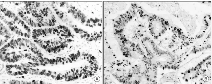 Fig.  3.  Immunohistochemical  staining  of  Ki-67.  Most  of  the  tumor  cells  are  stained  in  A,  but  only  small  portion  is  stained  in  B