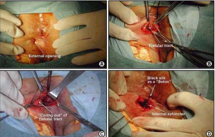 Fig.  1.  The  steps  of  operative  method.  (A)  It  shows  external  opening  of  the  fistula  at  2  o'clock  direction