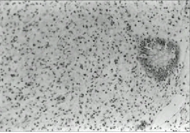 Fig. 1. Microscopic finding of colorectal signet ring cell car- car-cinoma (H&amp;E, 200).