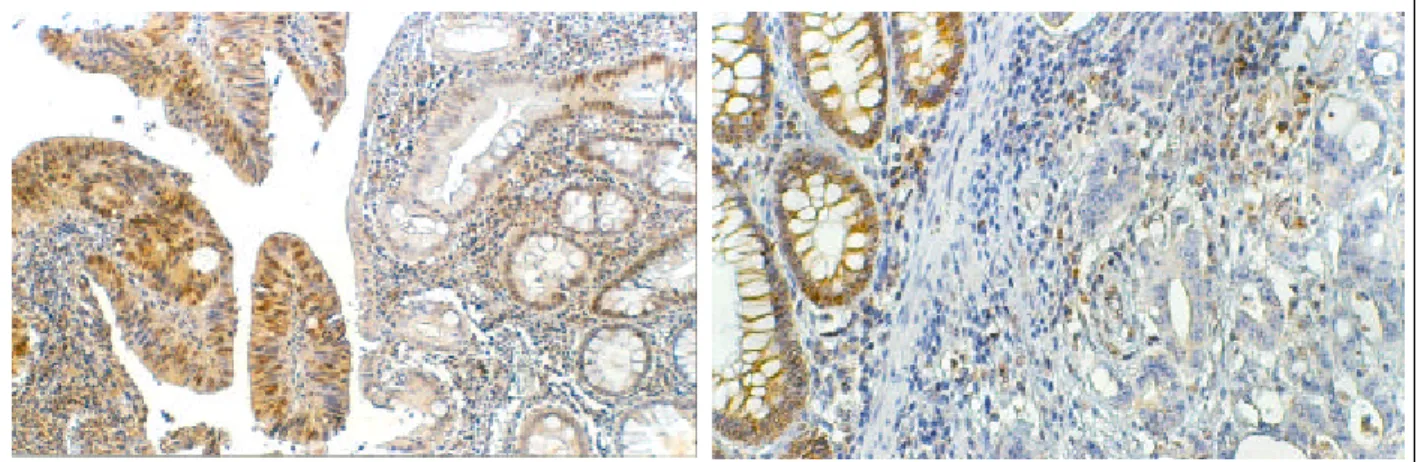 Fig. 4. A. Positive staining of normal control mucosa and adj acent tumor cells with hMSH2 ( 100)