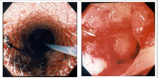 Fig. 2. Colo n c ancer specimen: Self-expandable metal stent was located adequatel y in o bstructed segment.